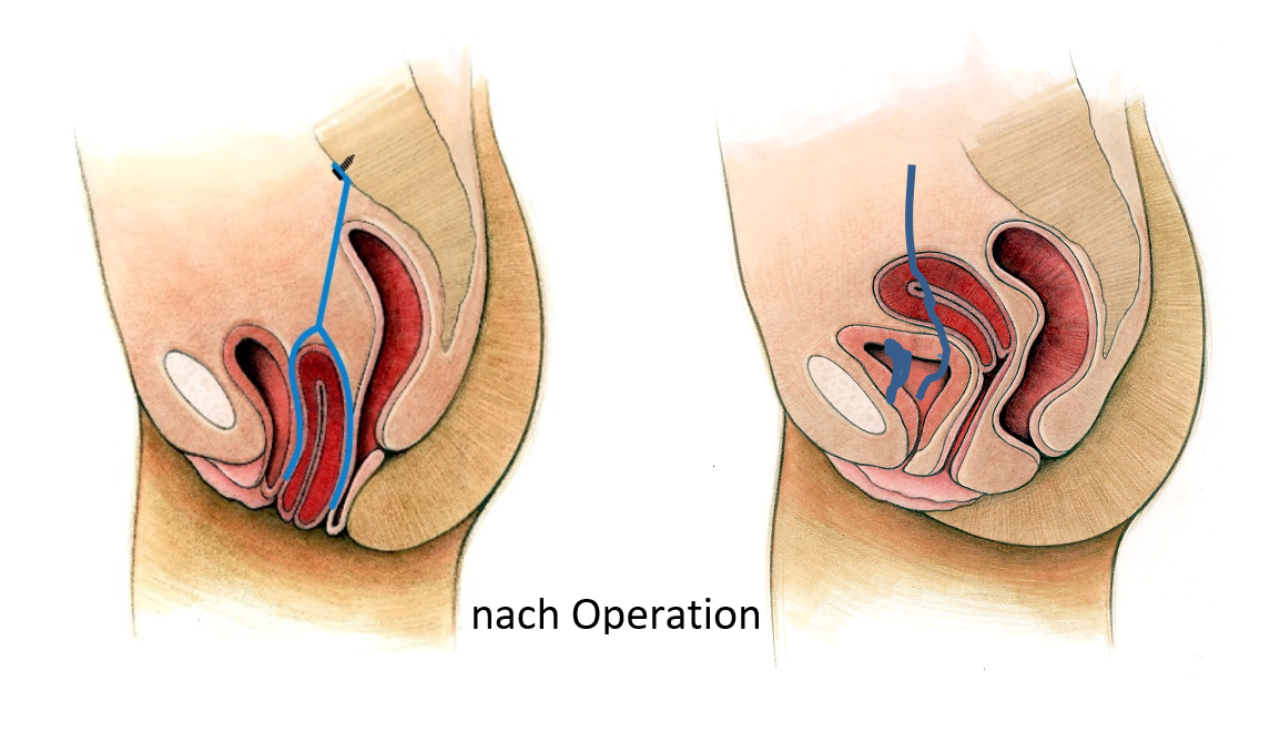 Schematische Darstellung der Netzposition bei durch Bauchspiegelung behobenem Gebärmuttervorfall