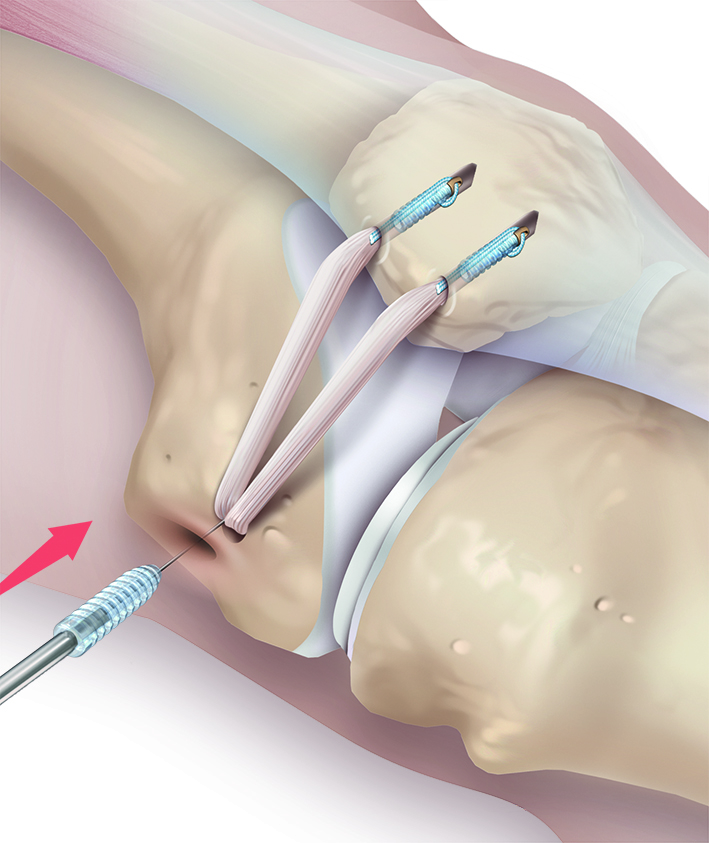 Patellastabilisierung 