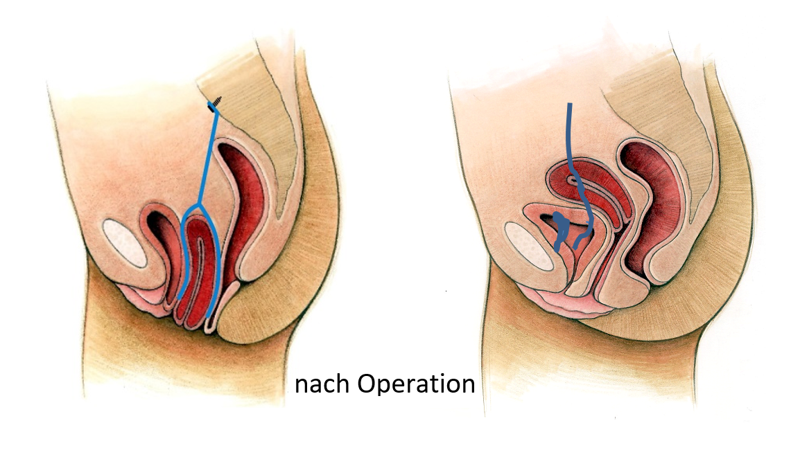 Senkungen Der Weiblichen Beckenorgane Kontinenzzentrum Diakonissen Speyer