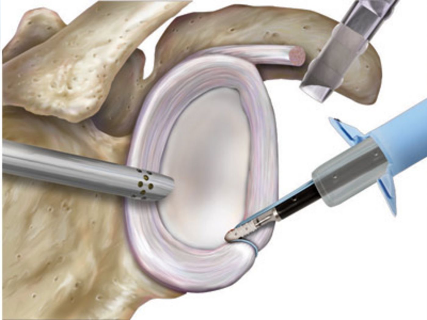 Arthroskopische Refixation der Gelenklippe