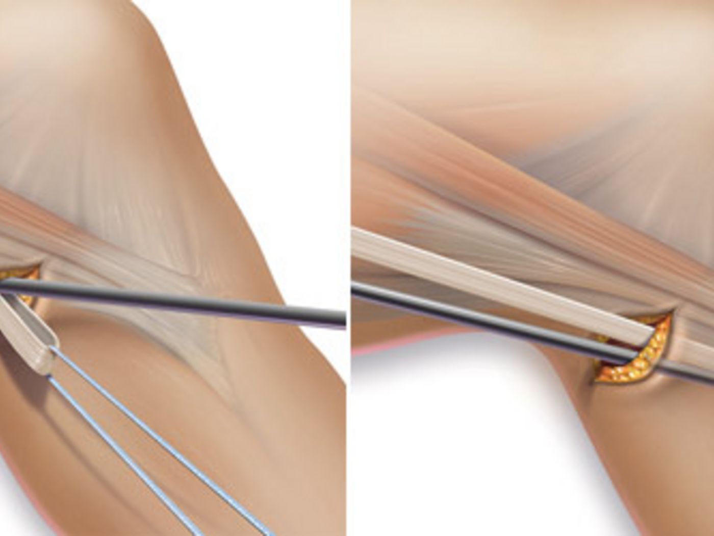 Minimalinvasive Sehnenentnahme aus der Kniekehle