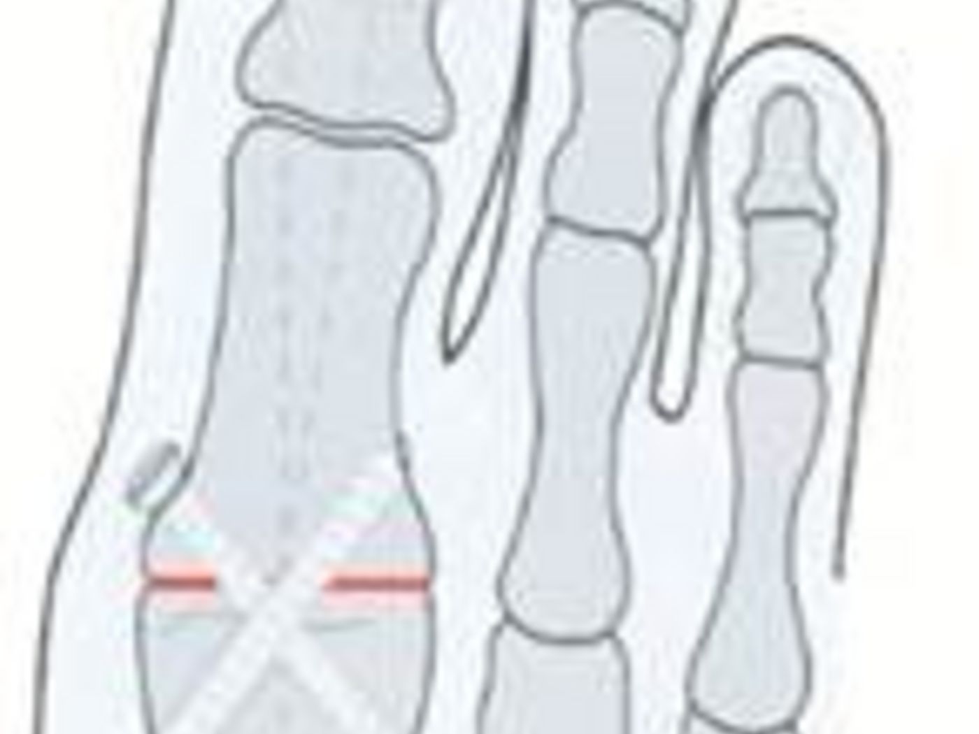 Hallus valgus