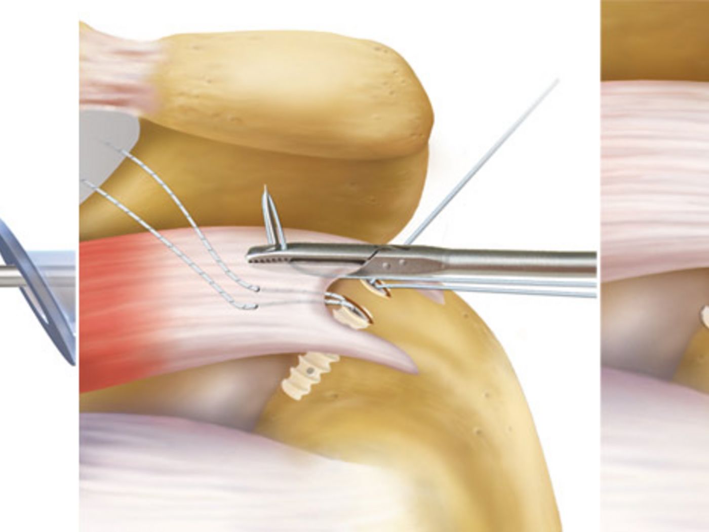 Arthroskopische Refixation der Rotatorenmanschette