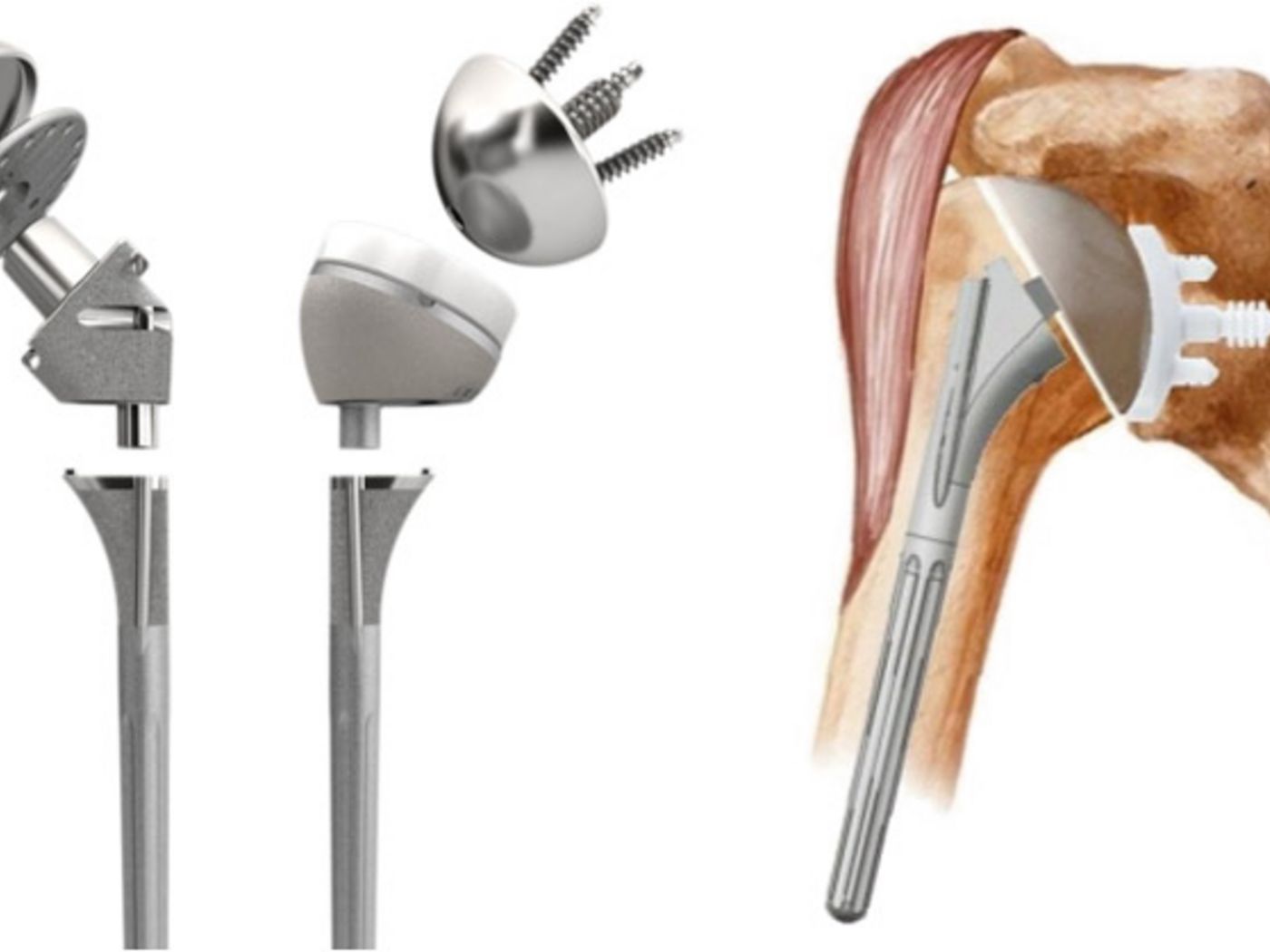 Modulare anatomische und inverse Schulterprothese